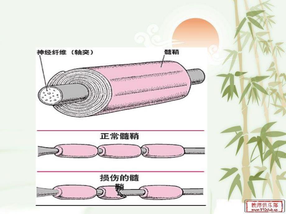 多发性硬化 演示文稿.ppt.ppt_第3页