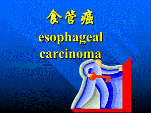 食管癌ppt.ppt