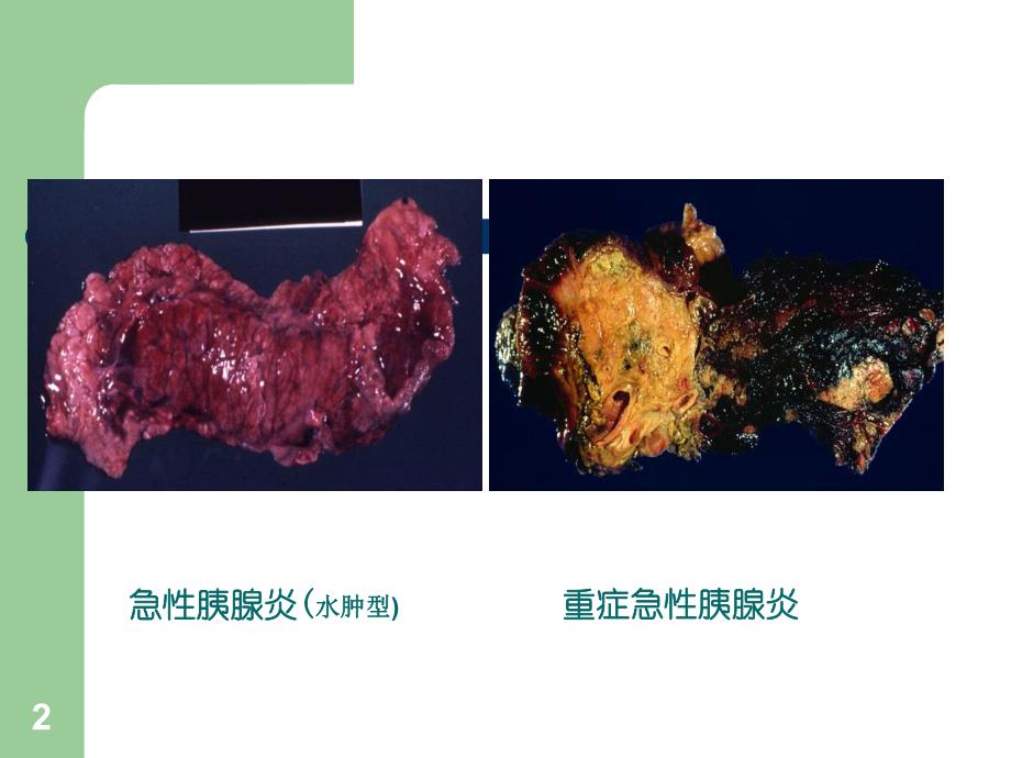 重症急性胰腺炎.ppt_第2页