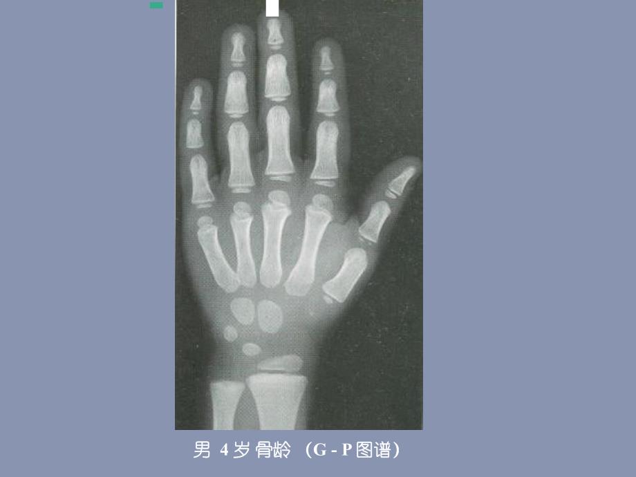 医院儿科培训PPT骨龄评估与成身高预测.ppt_第3页