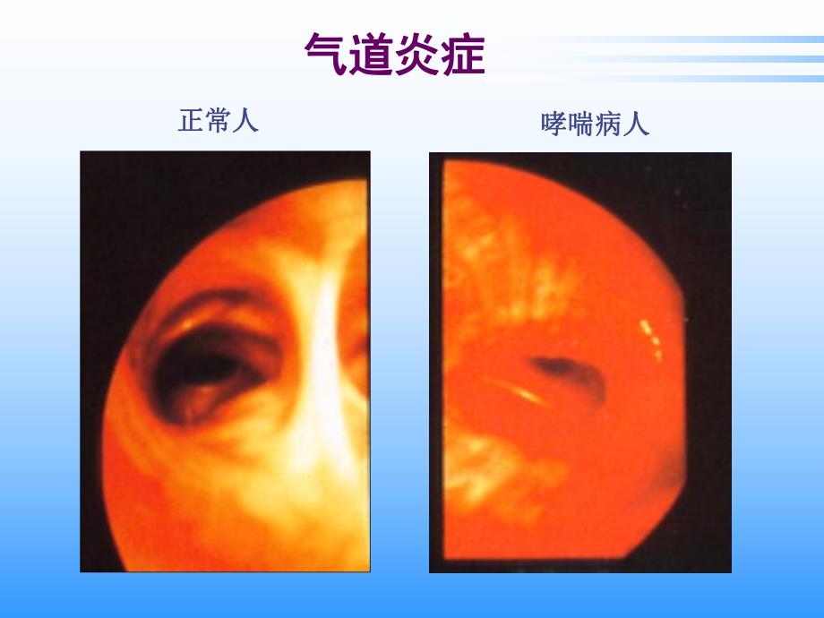 哮喘诊断和分级.ppt_第2页