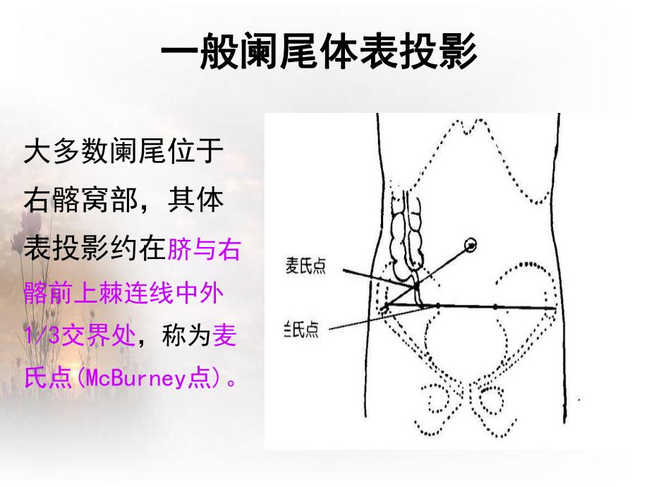 急性阑尾炎.ppt_第3页
