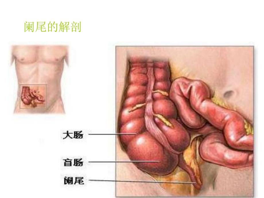 阑尾炎业务学习资料.ppt_第3页