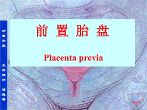 【精品】前置胎盘主讲教师腊晓琳前置胎盘79.ppt