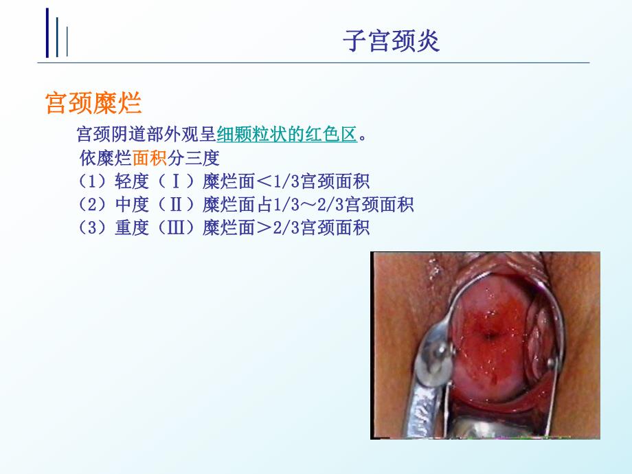 子宫颈炎.ppt_第3页