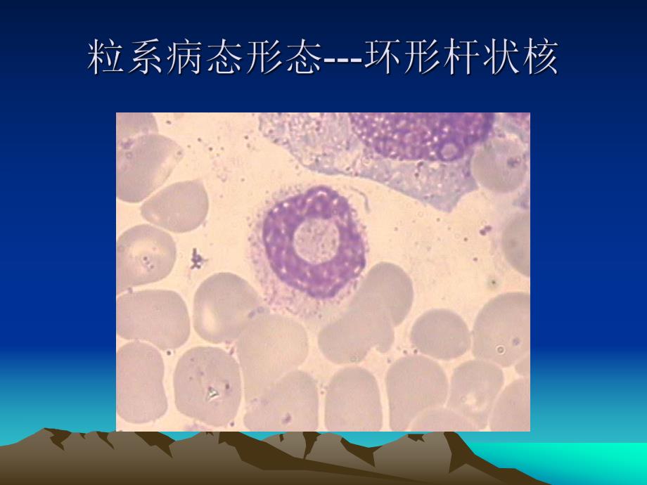 骨髓增生异常综合征.ppt_第3页