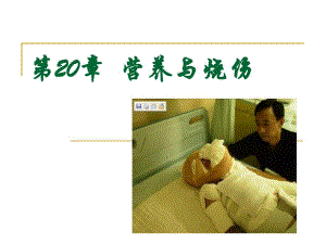 营养与烧伤ppt幻灯片.ppt