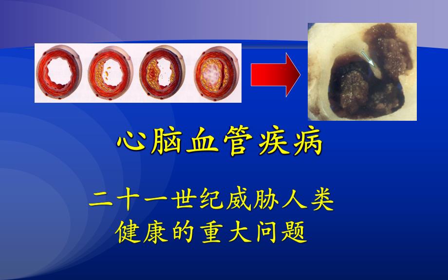 脉搏波传导速度的临床应用荟萃.ppt_第2页
