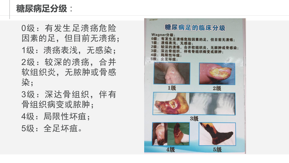 糖尿病足个案.ppt_第3页