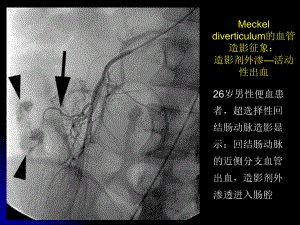 麦克尔憩室的影像学诊断.ppt