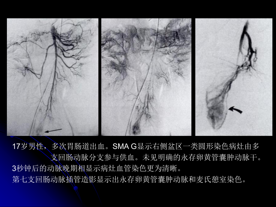 麦克尔憩室的影像学诊断.ppt_第2页