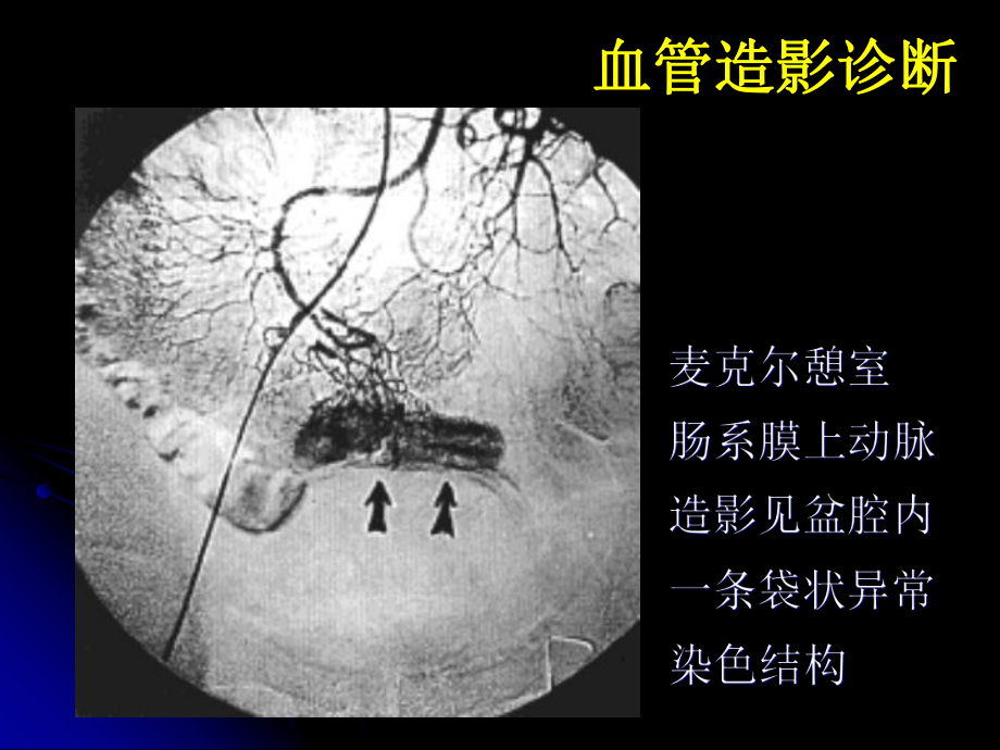 麦克尔憩室的影像学诊断.ppt_第3页