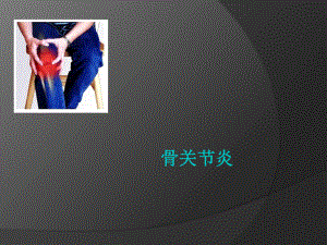 骨关节炎PPT课件.ppt