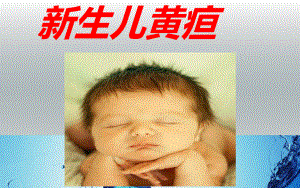 新生儿黄疸PPT.ppt