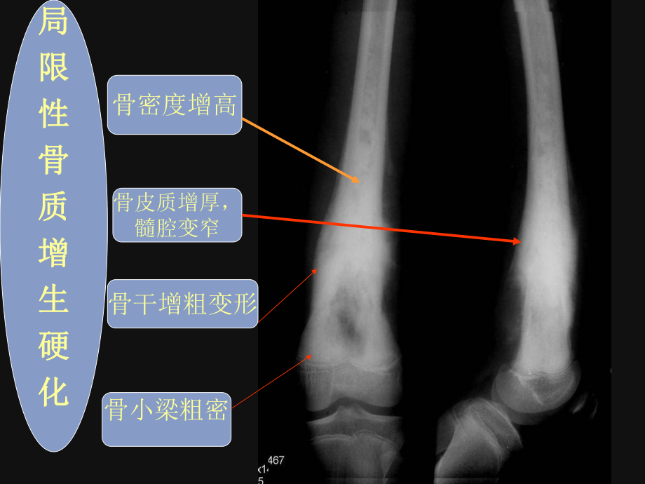 医学影像学课件骨关节.ppt_第3页