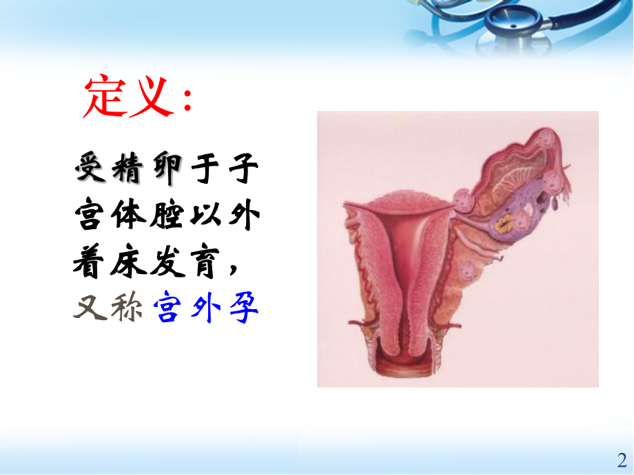 宫外孕的护理医学PPT课件.ppt_第2页