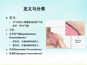气胸医学PPT课件.ppt