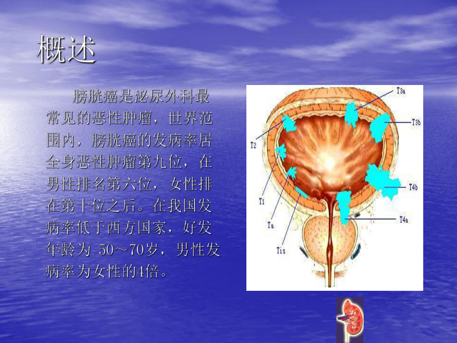 膀胱癌术后膀胱灌注的护理医学PPT课件.ppt_第2页