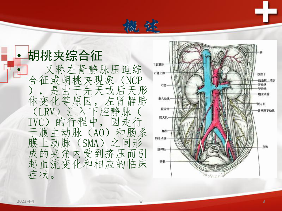 胡桃夹综合征PPT医学课件.ppt_第3页
