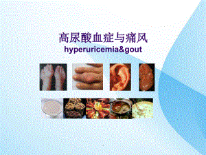 痛风课件PPT课件.ppt