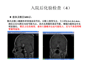 【医学课件】垂体占位PPT.pptx