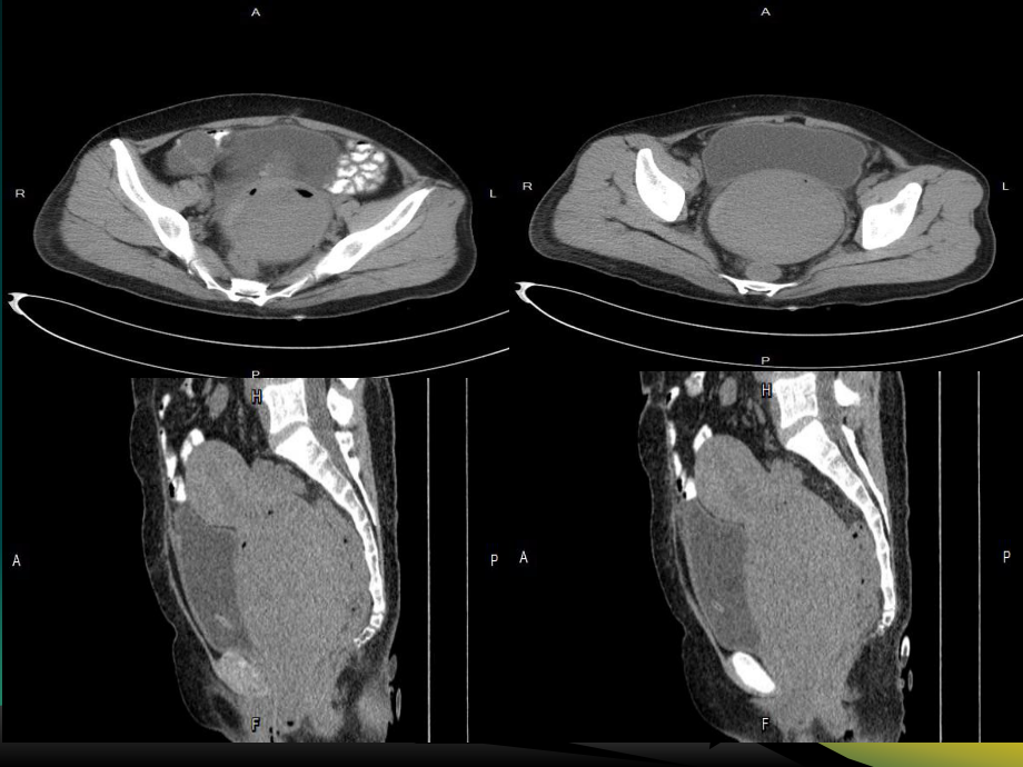 子宫肌瘤影像学诊断.pptx_第2页