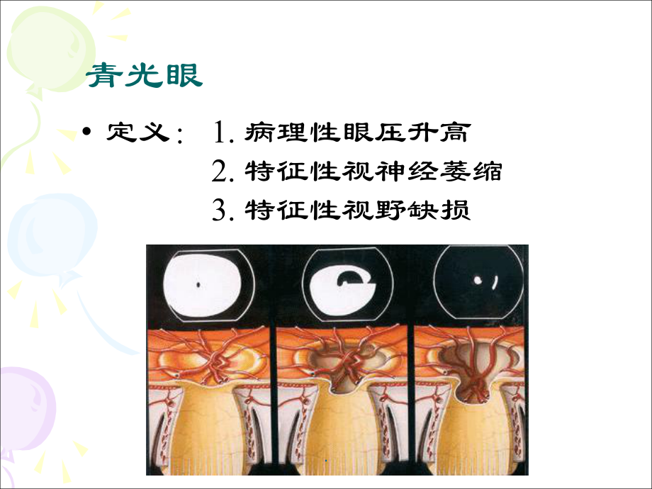 青光眼医学PPT课件.ppt_第3页