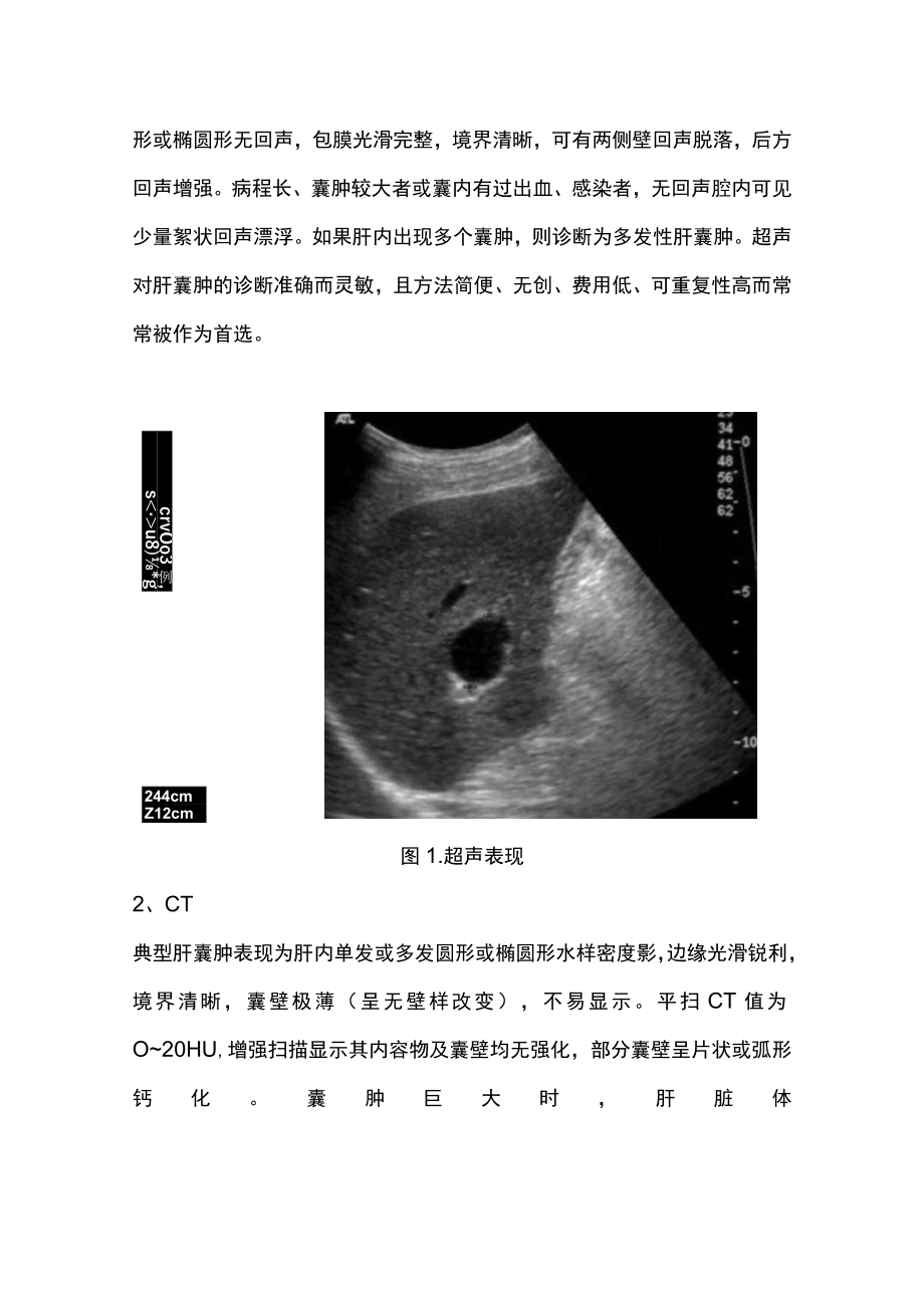 2022肝囊肿的常见临床表现、诊断与治疗方案（全文）.docx_第3页