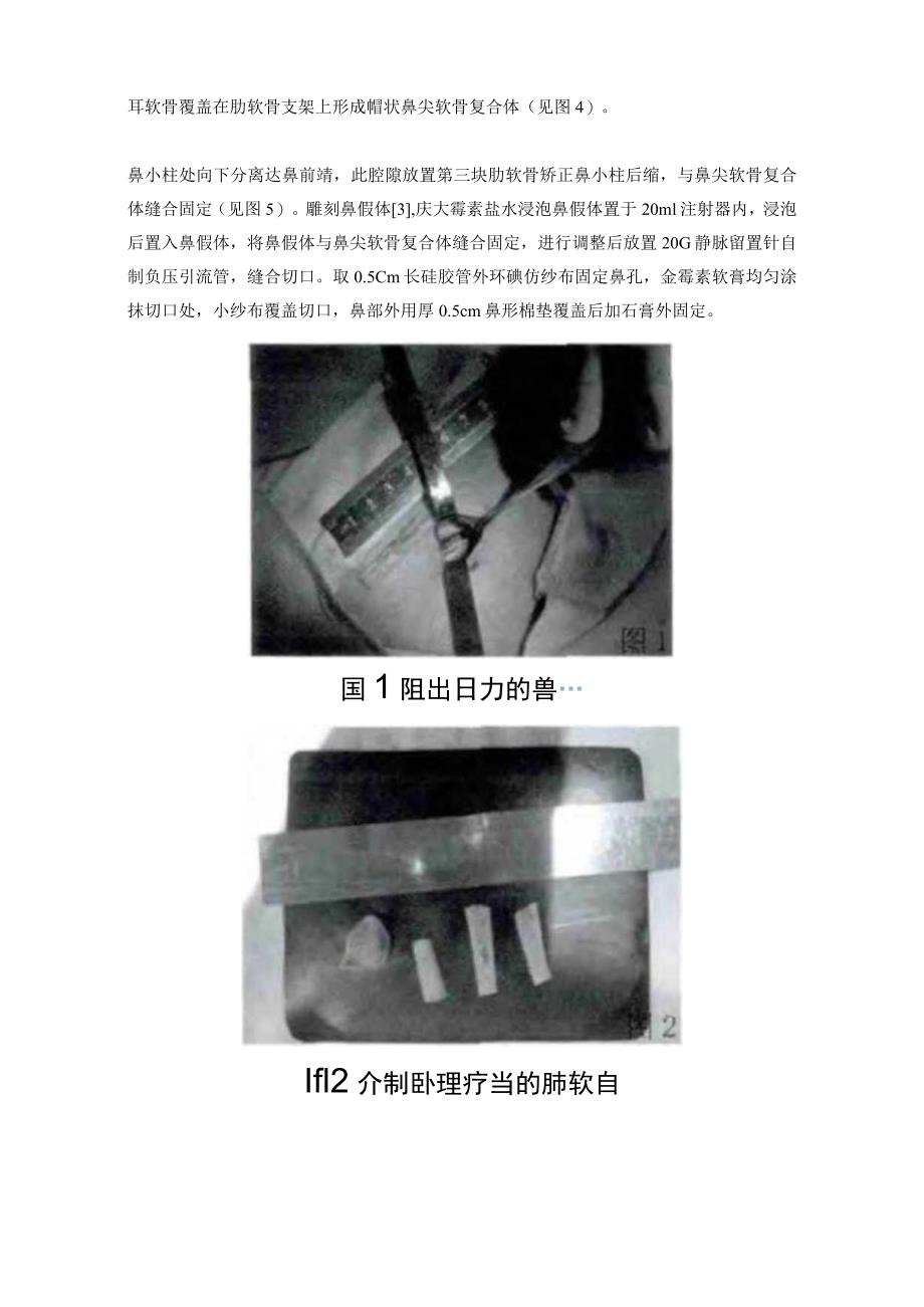 医美鼻整形肋软骨填充术基础临床护理知识.docx_第2页
