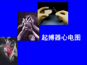 起搏器心电图.ppt