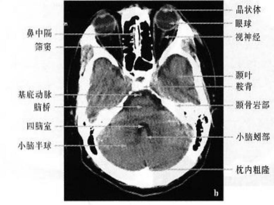颅脑CTMRI解剖3.ppt_第3页