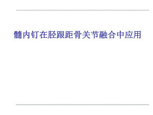 髓内钉在胫跟距骨关节融合中应用.ppt