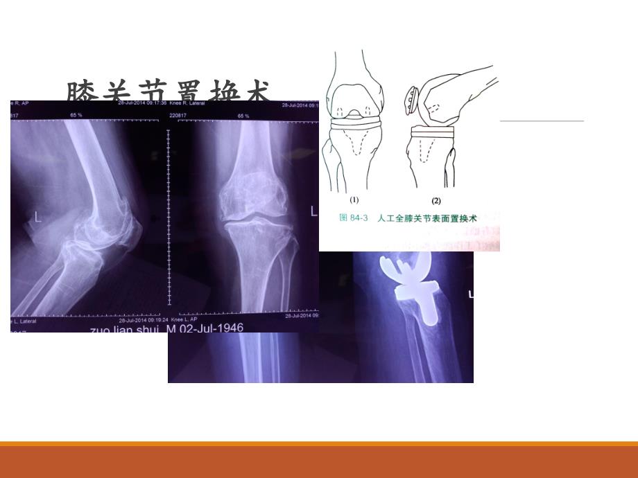 髋膝关节置换适应症和并发症.ppt_第2页