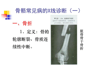 骨骼常见病的X线诊断一.ppt