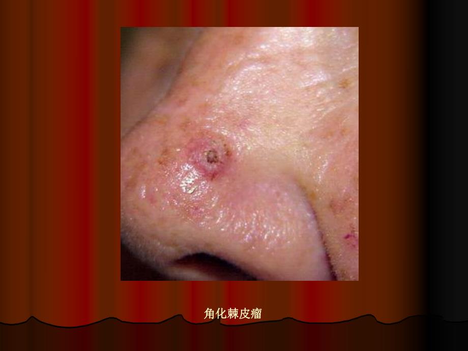 角化棘皮瘤图谱.ppt_第2页