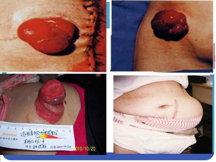 造口术前定位.ppt_第3页