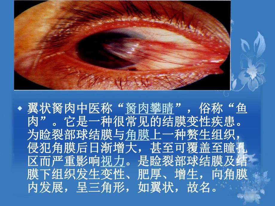 翼状胬肉及干眼症眼外伤等.ppt_第2页