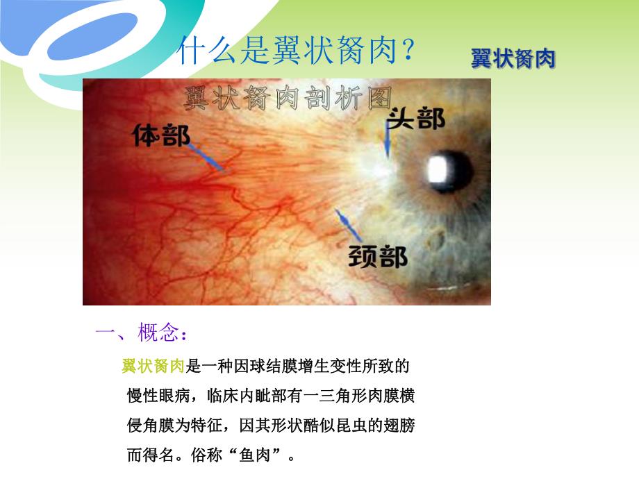 翼状胬肉的诊断与治疗.ppt_第2页