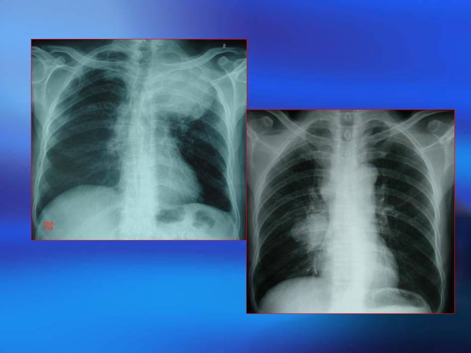 肺癌讲义PPT课件.ppt_第2页