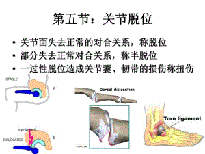 第五节关节脱位.ppt