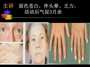 贫血anemia.ppt