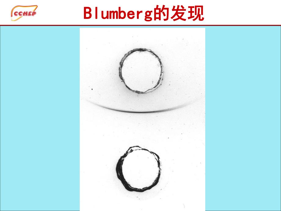 慢性乙型肝炎的诊断.ppt_第3页