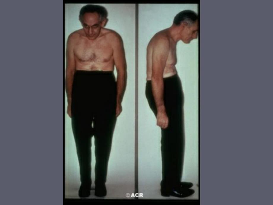 【医学课件】强直性脊柱炎.ppt_第2页