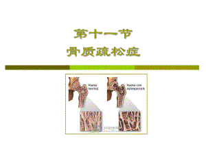 【精品】第十一节 骨质疏松症26.ppt