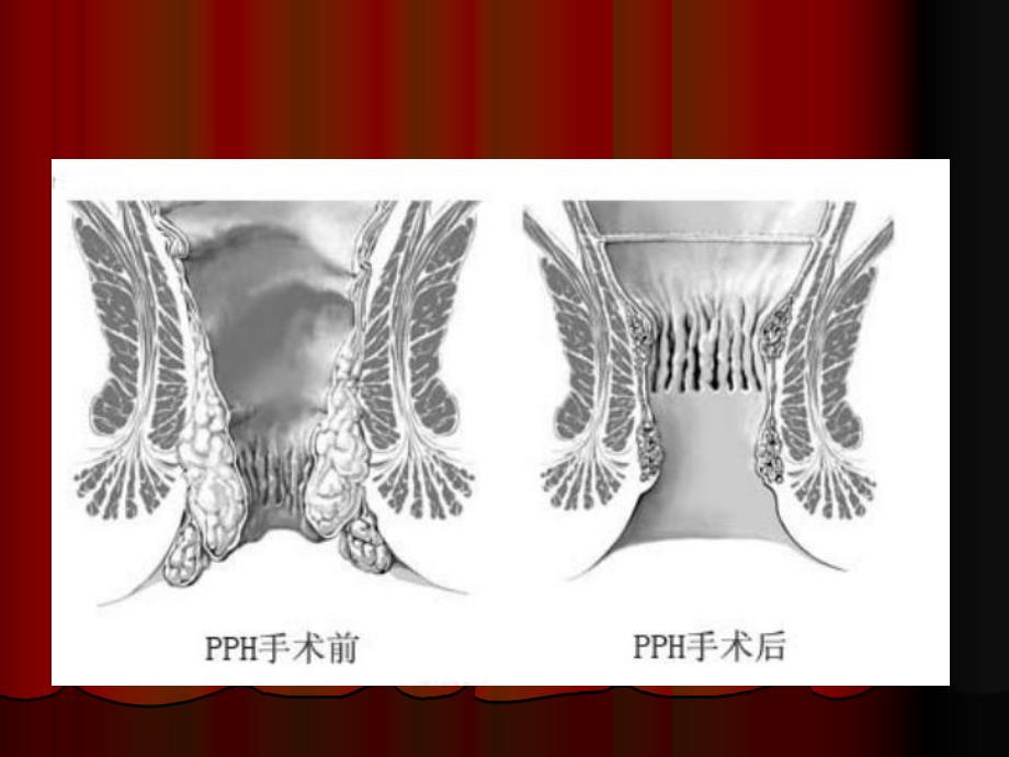 pph手术图文.ppt_第3页