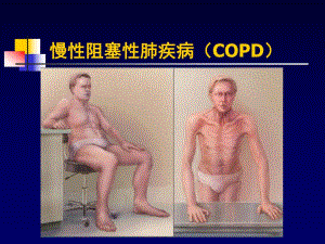 COPD一种伴有异常炎症反应的多因素构成的疾病.ppt