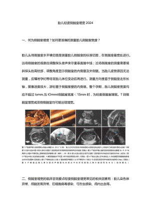 胎儿轻度侧脑室增宽2024.docx