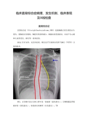 临床直背综合症病理、发生机制、临床表现及X线检查.docx