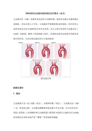 2024急性主动脉夹层机制及治疗要点（全文）.docx