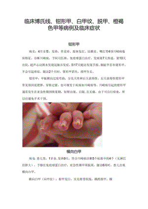 临床博氏线、钳形甲、白甲纹、脱甲、橙褐色甲等病例及临床症状.docx